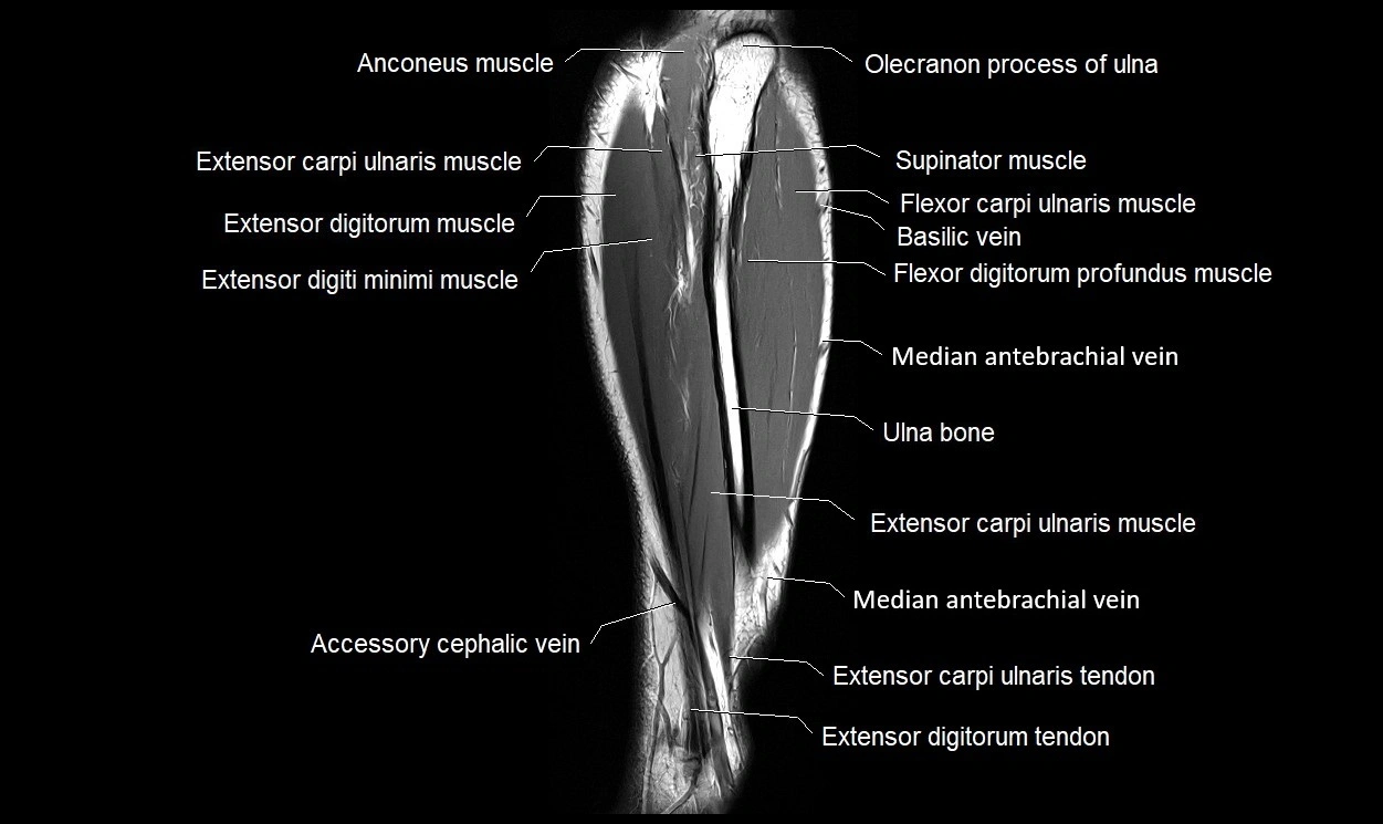 MRI 3T forearm coronal cross sectional anatomy image 22.webp